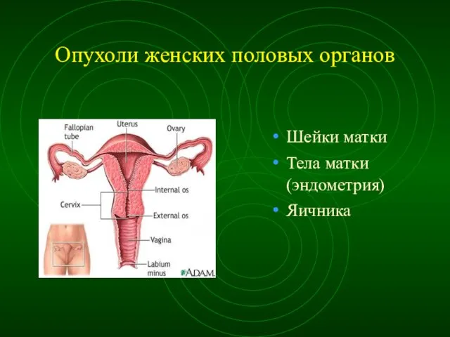 Опухоли женских половых органов Шейки матки Тела матки (эндометрия) Яичника