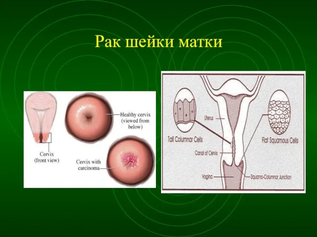 Рак шейки матки