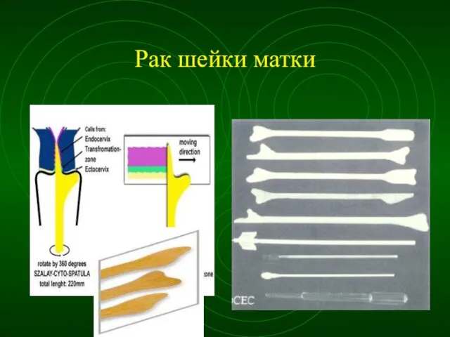 Рак шейки матки