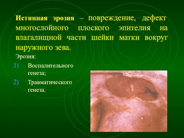 Истинная эрозия – повреждение, дефект многослойного плоского эпителия на влагалищной части