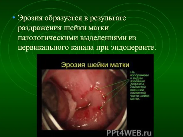 Эрозия образуется в результате раздражения шейки матки патологическими выделениями из цервикального канала при эндоцервите.