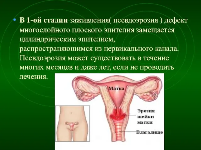 В 1-ой стадии заживления( псевдоэрозия ) дефект многослойного плоского эпителия замещается