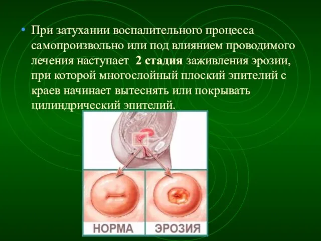 При затухании воспалительного процесса самопроизвольно или под влиянием проводимого лечения наступает