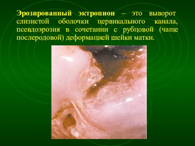 Эрозированный эктропион – это выворот слизистой оболочки цервикального канала, псевдоэрозия в