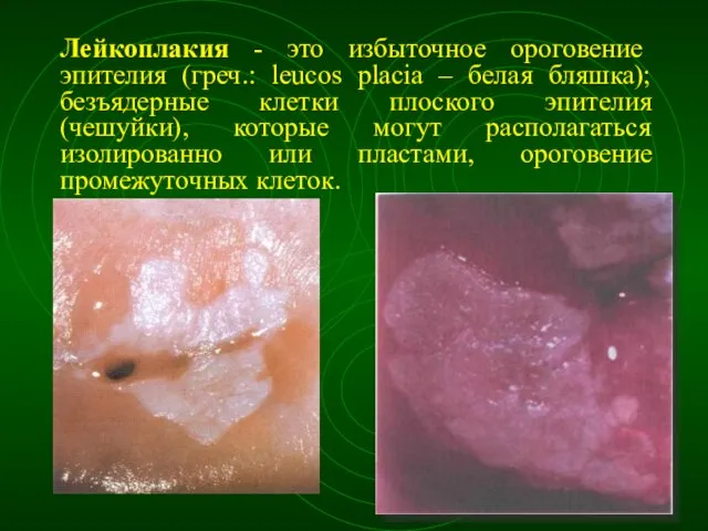 Лейкоплакия - это избыточное ороговение эпителия (греч.: leucos placia – белая