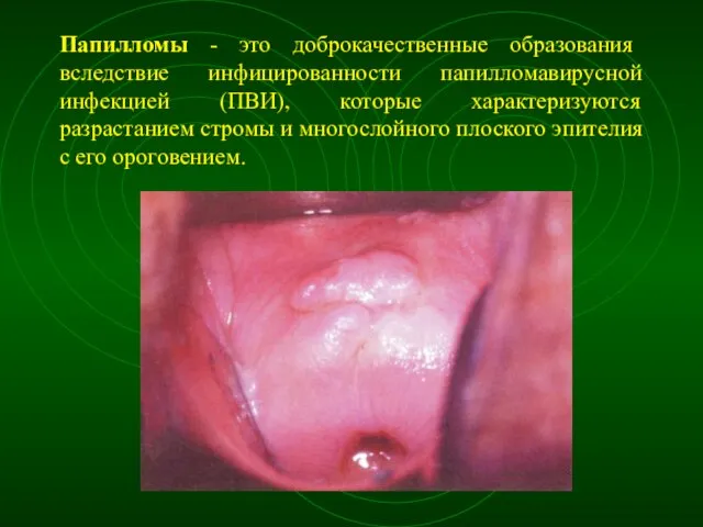 Папилломы - это доброкачественные образования вследствие инфицированности папилломавирусной инфекцией (ПВИ), которые