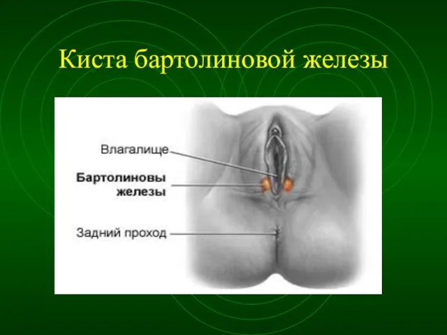 Киста бартолиновой железы