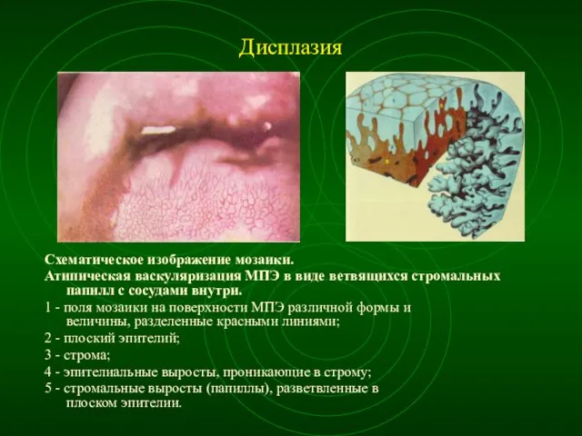 Дисплазия Схематическое изображение мозаики. Атипическая васкуляризация МПЭ в виде ветвящихся стромальных