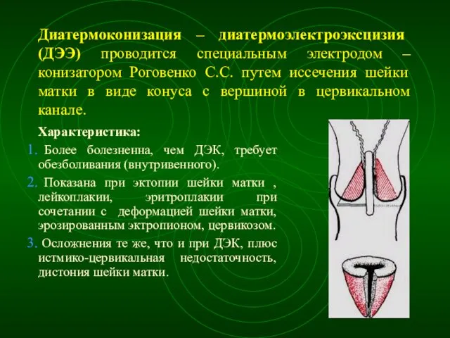 Диатермоконизация – диатермоэлектроэксцизия (ДЭЭ) проводится специальным электродом – конизатором Роговенко С.С.