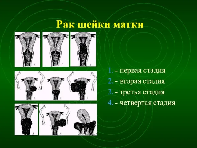 Рак шейки матки 1. - первая стадия 2. - вторая стадия