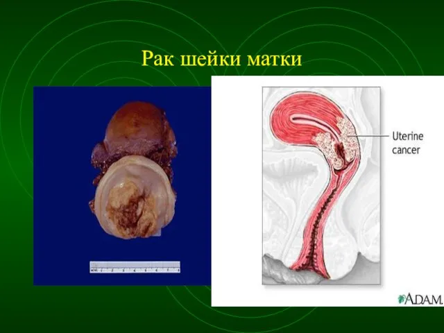 Рак шейки матки