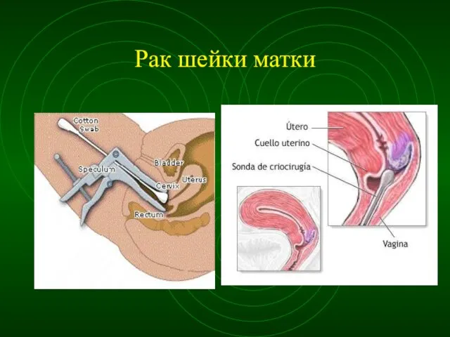 Рак шейки матки