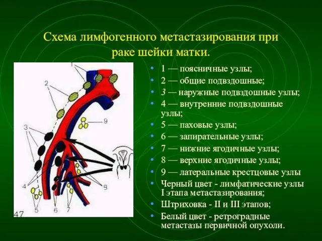 Схема лимфогенного метастазирования при раке шейки матки. 1 — поясничные узлы;