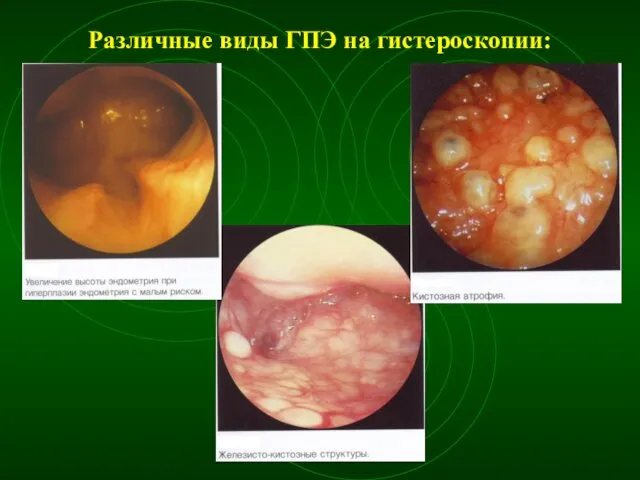 Различные виды ГПЭ на гистероскопии: