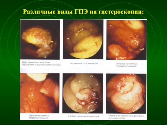 Различные виды ГПЭ на гистероскопии: