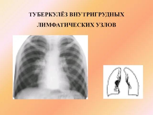 ТУБЕРКУЛЁЗ ВНУТРИГРУДНЫХ ЛИМФАТИЧЕСКИХ УЗЛОВ