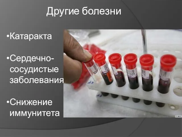 Другие болезни Катаракта Сердечно-сосудистые заболевания Снижение иммунитета