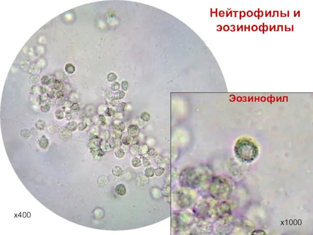 Нейтрофилы и эозинофилы Эозинофил х400 х1000