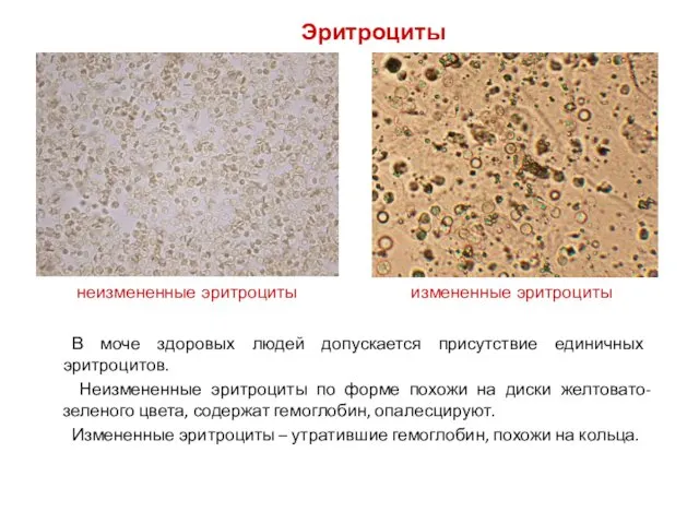 В моче здоровых людей допускается присутствие единичных эритроцитов. Неизмененные эритроциты по