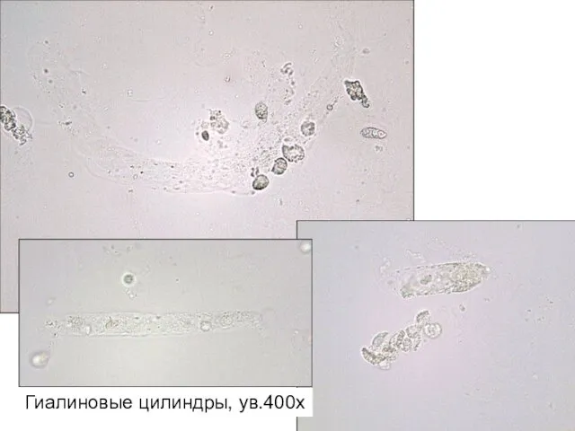 Гиалиновые цилиндры, ув.400х