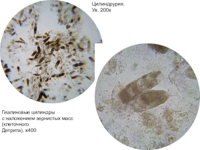 Цилиндрурия. Ув. 200х Гиалиновые цилиндры с наложением зернистых масс (клеточного Детрита). х400