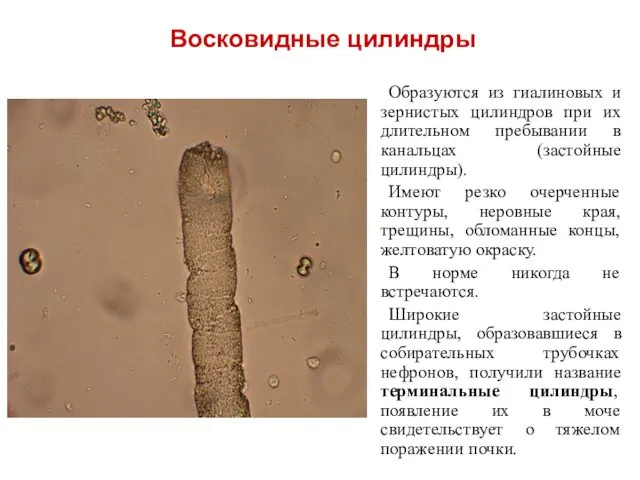 Образуются из гиалиновых и зернистых цилиндров при их длительном пребывании в