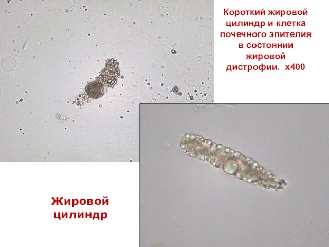 Короткий жировой цилиндр и клетка почечного эпителия в состоянии жировой дистрофии. х400 Жировой цилиндр