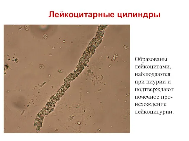 Образованы лейкоцитами, наблюдаются при пиурии и подтверждают почечное про-исхождение лейкоцитурии. Лейкоцитарные цилиндры