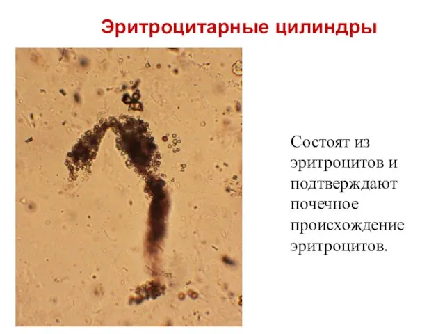 Состоят из эритроцитов и подтверждают почечное происхождение эритроцитов. Эритроцитарные цилиндры