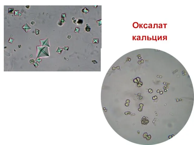 Оксалат кальция