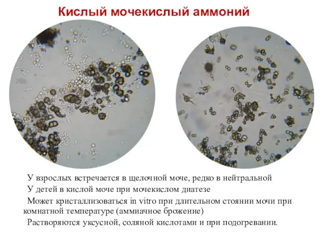 Кислый мочекислый аммоний У взрослых встречается в щелочной моче, редко в