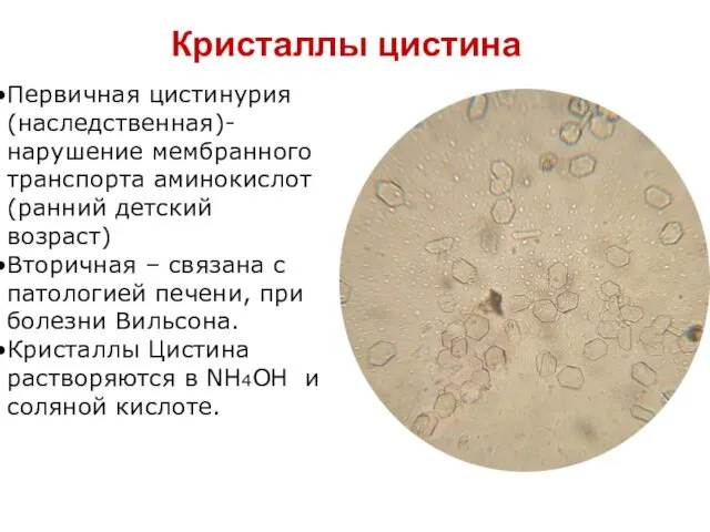 Кристаллы цистина Первичная цистинурия (наследственная)- нарушение мембранного транспорта аминокислот (ранний детский