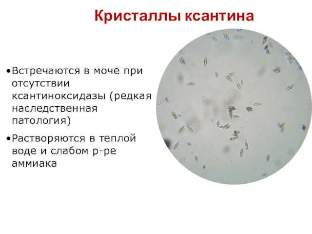 Кристаллы ксантина Встречаются в моче при отсутствии ксантиноксидазы (редкая наследственная патология)