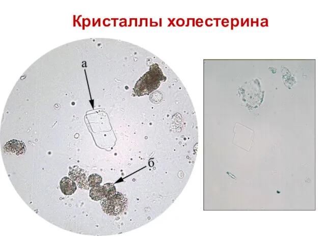 Кристаллы холестерина