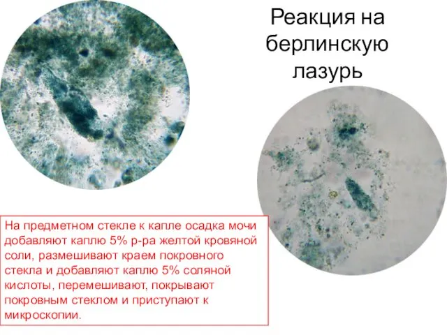 Реакция на берлинскую лазурь На предметном стекле к капле осадка мочи