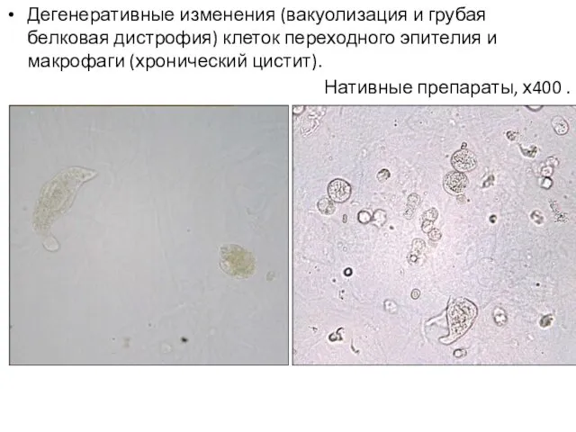 Дегенеративные изменения (вакуолизация и грубая белковая дистрофия) клеток переходного эпителия и