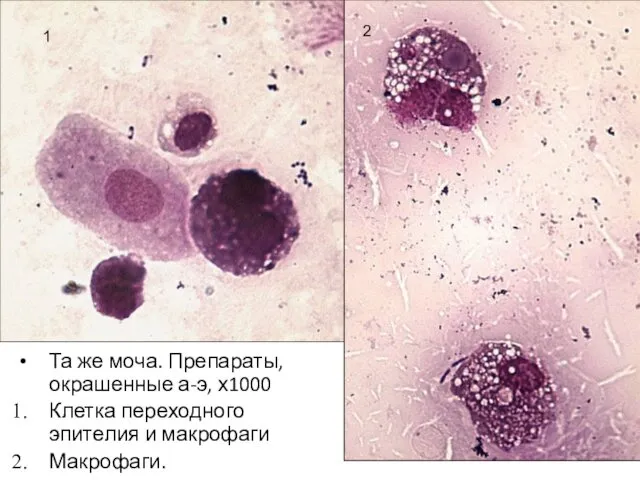 Та же моча. Препараты, окрашенные а-э, х1000 Клетка переходного эпителия и макрофаги Макрофаги. 1 2