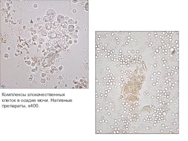 Комплексы злокачественных клеток в осадке мочи. Нативные препараты, х400.