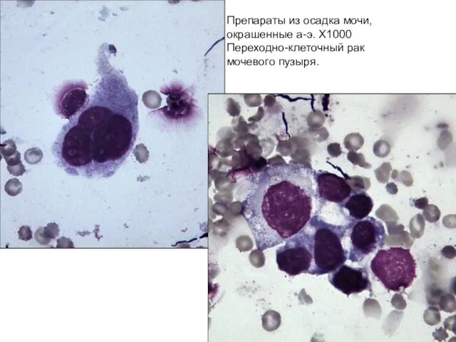 Препараты из осадка мочи, окрашенные а-э. Х1000 Переходно-клеточный рак мочевого пузыря.