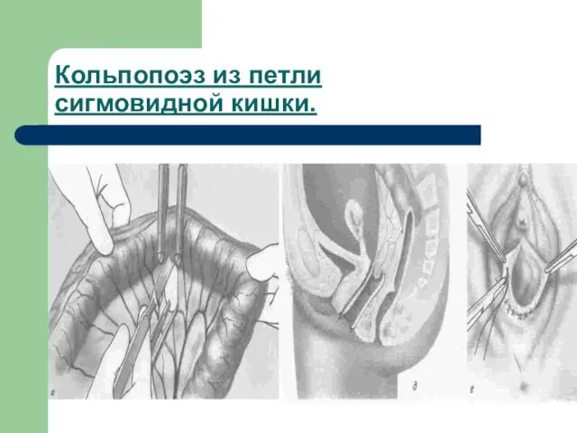 Кольпопоэз из петли сигмовидной кишки.