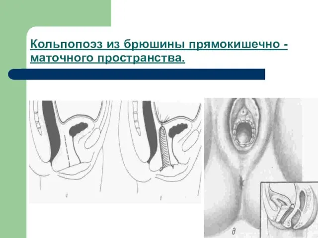 Кольпопоэз из брюшины прямокишечно - маточного пространства.