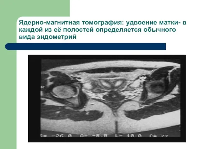 Ядерно-магнитная томография: удвоение матки- в каждой из её полостей определяется обычного вида эндометрий