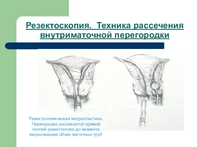 Резектоскопия. Техника рассечения внутриматочной перегородки Резектоскопическая метропластика. Перегородка рассекается прямой петлей