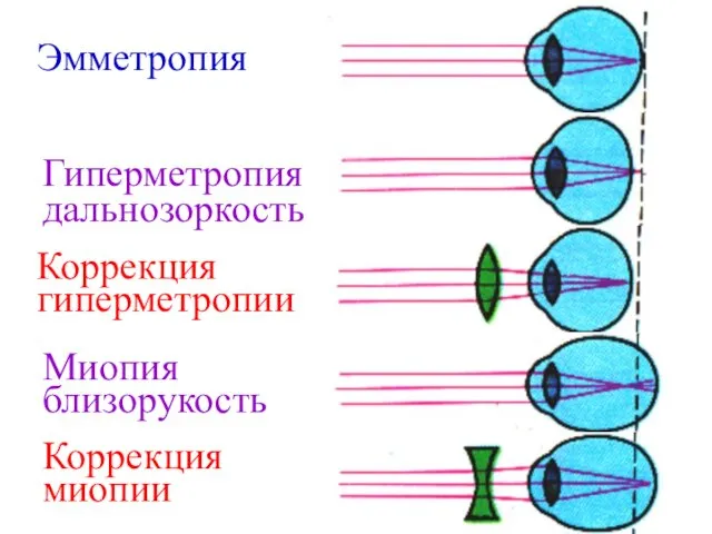 Эмметропия Гиперметропия дальнозоркость Коррекция гиперметропии Миопия близорукость Коррекция миопии