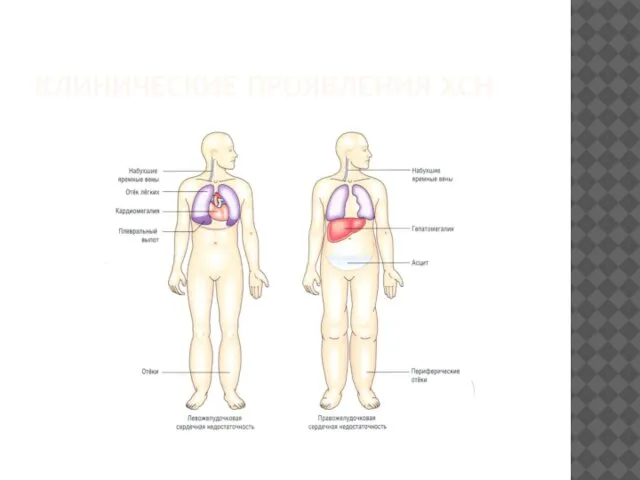КЛИНИЧЕСКИЕ ПРОЯВЛЕНИЯ ХСН