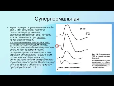 Супернормальная характеризуется увеличением а- и Ь-волн, что, возможно, является следствием раздражения