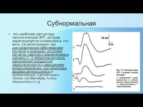 Субнормальная это наиболее частый вид патологической ЭРГ, которая характеризуется снижением а-