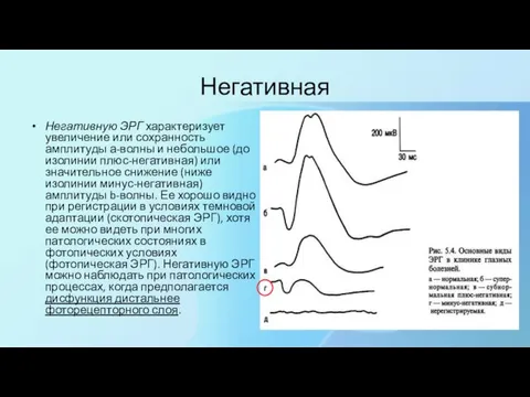 Негативная Негативную ЭРГ характеризует увеличение или сохранность амплитуды а-волны и небольшое