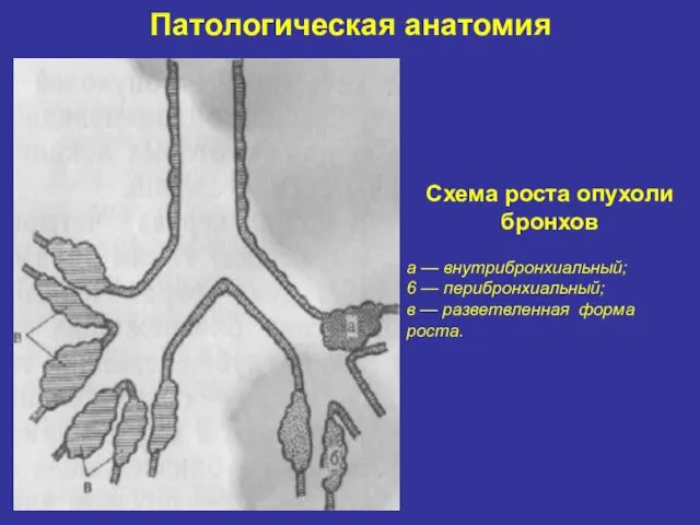 Патологическая анатомия Схема роста опухоли бронхов а — внутрибронхиальный; 6 —