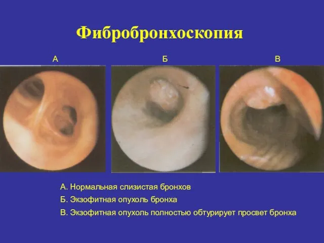 Фибробронхоскопия А. Нормальная слизистая бронхов Б. Экзофитная опухоль бронха В. Экзофитная